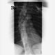 Spinal Cord Injuries Are Serious - Tindall Law Firm, CT