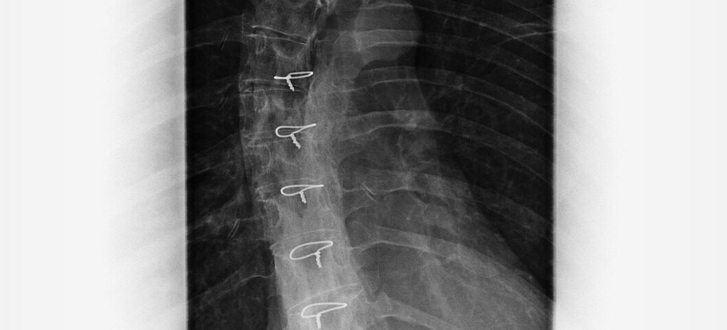 Spinal Cord Injuries Are Serious - Tindall Law Firm, CT